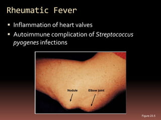 Rheumatic Fever
 Inflammation of heart valves
 Autoimmune complication of Streptococcus
  pyogenes infections




                                             Figure 23.5
 