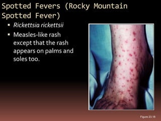 Spotted Fevers (Rocky Mountain
Spotted Fever)
  Rickettsia rickettsii
  Measles-like rash
   except that the rash
   appears on palms and
   soles too.




                                 Figure 23.18
 