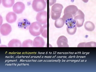 P. malariae schizonts: have 6 to 12 merozoites with large
nuclei, clustered around a mass of coarse, dark-brown
pigment. Merozoites can occasionally be arranged as a
rosette pattern.
 