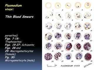 Plasmodium
vivax: Blood Stage
Parasites
Thin Blood Smears

Fig. 1: Normal red cell;
Figs. 2-6: Young
trophozoites (ring stage
parasites);
Figs. 7-18:
Trophozoites;
Figs. 19-27: Schizonts;
Figs. 28 and
29: Macrogametocytes
(female);
Fig. 30:
Microgametocyte (male).
 