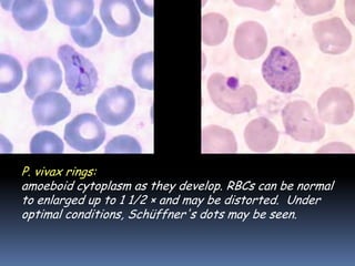 P. vivax rings: have large chromatin dots and can show
amoeboid cytoplasm as they develop. RBCs can be normal
to enlarged up to 1 1/2 × and may be distorted. Under
optimal conditions, Schüffner's dots may be seen.
 