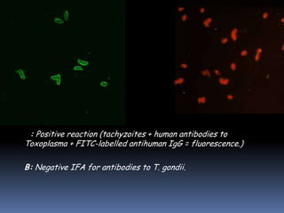 A: Positive reaction (tachyzoites + human antibodies to
Toxoplasma + FITC-labelled antihuman IgG = fluorescence.)

B: Negative IFA for antibodies to T. gondii.
 