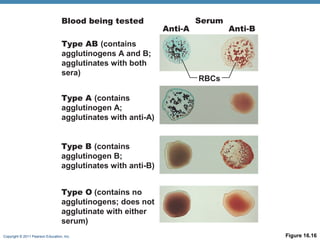 Blood being tested
Type AB (contains
agglutinogens A and B;
agglutinates with both
sera)

Anti-A

Serum

Anti-B

RBCs

Type A (contains
agglutinogen A;
agglutinates with anti-A)
Type B (contains
agglutinogen B;
agglutinates with anti-B)
Type O (contains no
agglutinogens; does not
agglutinate with either
serum)
Copyright © 2011 Pearson Education, Inc.

Figure 16.16

 