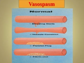 Vasospasm
 