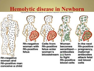 Hemolytic disease in Newborn
 
