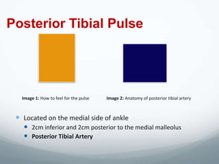 Posterior Tibial Pulse




   Image 1: How to feel for the pulse   Image 2: Anatomy of posterior tibial artery



  Located on the medial side of ankle
    2cm inferior and 2cm posterior to the medial malleolus
    Posterior Tibial Artery
 