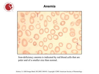 Anemia




   Iron-deficiency anemia is indicated by red blood cells that are
   paler and of a smaller size than normal.



Schrier, S. ASH Image Bank 202;2002:100345. Copyright ©2002 American Society of Hematology.
 