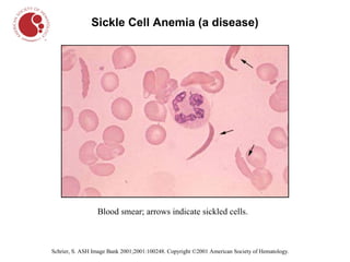 Sickle Cell Anemia (a disease)




                 Blood smear; arrows indicate sickled cells.



Schrier, S. ASH Image Bank 2001;2001:100248. Copyright ©2001 American Society of Hematology.
 
