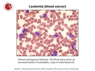 Leukemia (blood cancer)




    Chronic myelogenous leukemia. The blood smear shows an
    increased number of neutrophils, a type of white blood cell.

Maslak, P. ASH Image Bank 2001;2001:100202. Copyright ©2001 American Society of Hematology.
 