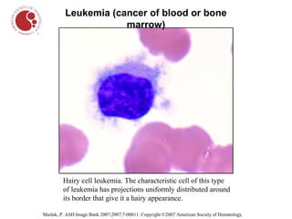 Leukemia (cancer of blood or bone
                      marrow)




         Hairy cell leukemia. The characteristic cell of this type
         of leukemia has projections uniformly distributed around
         its border that give it a hairy appearance.

Maslak, P. ASH Image Bank 2007;2007:7-00011. Copyright ©2007 American Society of Hematology.
 
