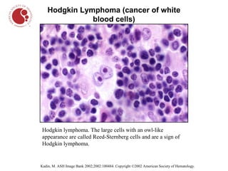 Hodgkin Lymphoma (cancer of white
               blood cells)




Hodgkin lymphoma. The large cells with an owl-like
appearance are called Reed-Sternberg cells and are a sign of
Hodgkin lymphoma.


Kadin, M. ASH Image Bank 2002;2002:100484. Copyright ©2002 American Society of Hematology.
 
