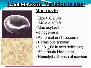Macrocyte
•Size > 8.2 µm
• MCV > 100 fL
• Macrocytosis
Pathogenesis
- Abnormal erythropoiesis
- Pernicious anemia
- Vit.B12,Folic acid deficiency
- After acute blood loss
- Hemolytic disease of newborn
1 Anisocytosis (Variation in size)
 