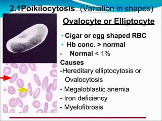 2.1Poikilocytosis (Variation in shapes)
Ovalocyte or Elliptocyte
• Cigar or egg shaped RBC
• Hb conc. > normal
- Normal < 1%
Causes
-Hereditary elliptocytosis or
Ovalocytosis
- Megaloblastic anemia
- Iron deficiency
- Myelofibrosis
 
