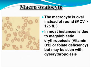 ●The macrocyte is oval
instead of round (MCV >
125 fL )
●In most instances is due
to megaloblastic
erythropoiesis (Vitamin
B12 or folate deficiency)
but may be seen with
dyserythropoiesis
 