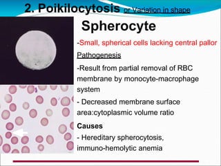 -Small, spherical cells lacking central pallor
Pathogenesis
-Result from partial removal of RBC
membrane by monocyte-macrophage
system
- Decreased membrane surface
area:cytoplasmic volume ratio
Causes
- Hereditary spherocytosis,
immuno-hemolytic anemia
2. Poikilocytosis or Variation in shape
Spherocyte
 