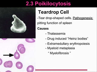 2.3 Poikilocytosis
Teardrop Cell
-Tear drop-shaped cells. Pathogenesis:
pitting function of spleen
Causes
- Thalassemia
- Drug induced “Heinz bodies”
- Extramedullary erythropoiesis
- Myeloid metaplasia
“ Myelofibrosis ”
 