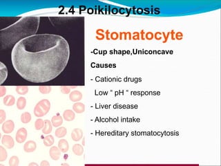 Stomatocyte
-Cup shape,Uniconcave
Causes
- Cationic drugs
Low “ pH “ response
- Liver disease
- Alcohol intake
- Hereditary stomatocytosis
2.4 Poikilocytosis
 