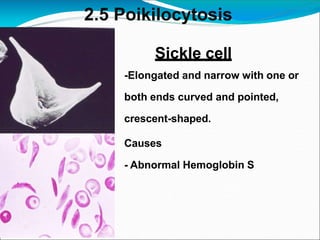 2.5 Poikilocytosis
Sickle cell
-Elongated and narrow with one or
both ends curved and pointed,
crescent-shaped.
Causes
- Abnormal Hemoglobin S
 
