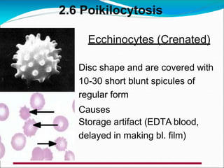 2.6 Poikilocytosis
Ecchinocytes (Crenated)
Disc shape and are covered with
10-30 short blunt spicules of
regular form
Causes
Storage artifact (EDTA blood,
delayed in making bl. film)
 
