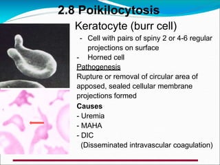 - Cell with pairs of spiny 2 or 4-6 regular
projections on surface
- Horned cell
Pathogenesis
Rupture or removal of circular area of
apposed, sealed cellular membrane
projections formed
Causes
- Uremia
- MAHA
- DIC
(Disseminated intravascular coagulation)
Keratocyte (burr cell)
2.8 Poikilocytosis
 