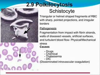Schistocyte
Triangular or helmet shaped fragments of RBC
with sharp, pointed projections, and irregular
borders
Pathogenesis
Fragmentation from impact with fibrin strands,
walls of diseased vessels, artificial surfaces,
and turbulent blood flow- Physical/Mechanical
stress
Causes
- Drugs
- Chemical
- Thalassemia
- DIC
(Disseminated intravascular coagulation)
2.9 Poikilocytosis
 