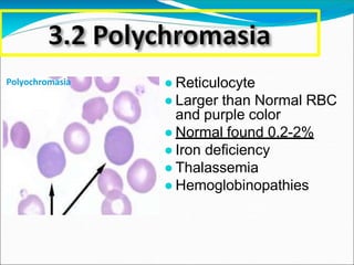 ● Reticulocyte
● Larger than Normal RBC
and purple color
● Normal found 0.2-2%
● Iron deficiency
● Thalassemia
● Hemoglobinopathies
Polyochromasia
 
