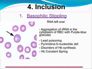 4. Inclusion
1. Basophilic Stippling
RNA left over
- Aggregation of rRNA in the
cytoplasm of RBC with Purple-blue
granules
- Lead poisoning
- Pyrimidine-5-nucleotide def.
- Disorders of Hb synthesis
- Hb Constant Spring
 