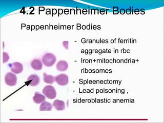 4.2 Pappenheimer Bodies
Pappenheimer Bodies
- Granules of ferritin
aggregate in rbc
- Iron+mitochondria+
ribosomes
- Spleenectomy
- Lead poisoning ,
sideroblastic anemia
 