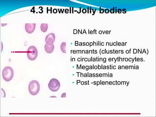 4.3 Howell-Jolly bodies
DNA left over
• Basophilic nuclear
remnants (clusters of DNA)
in circulating erythrocytes.
• Megaloblastic anemia
• Thalassemia
• Post -splenectomy
 