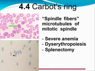 “Spindle fibers”
microtubules of
mitotic spindle
- Severe anemia
- Dyserythropoiesis
- Splenectomy
4.4 Carbot’s ring
 