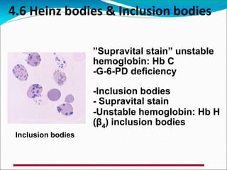 4.6 Heinz bodies & Inclusion bodies
”Supravital stain” unstable
hemoglobin: Hb C
-G-6-PD deficiency
-Inclusion bodies
- Supravital stain
-Unstable hemoglobin: Hb H
(β4) inclusion bodies
Inclusion bodies
 