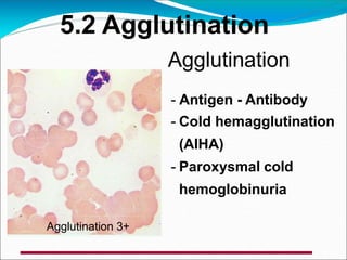 5.2 Agglutination
Agglutination
- Antigen - Antibody
- Cold hemagglutination
(AIHA)
- Paroxysmal cold
hemoglobinuria
Agglutination 3+
 