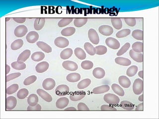 Ovalocytosis 3+
 