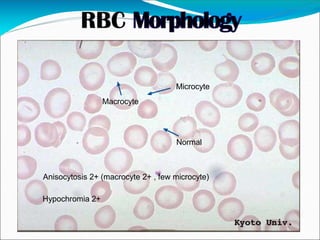 Normal
Microcyte
Macrocyte
Anisocytosis 2+ (macrocyte 2+ , few microcyte)
Hypochromia 2+
 