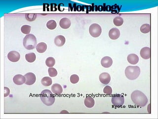 Anemia, spherocyte 3+, polychromasia 2+
 