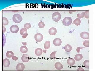 Schistocyte 1+, polychromasia 2+
 