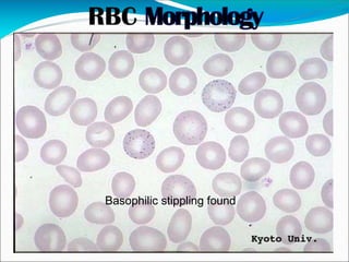 Basophilic stippling found
 