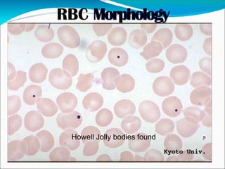 Howell Jolly bodies found
 
