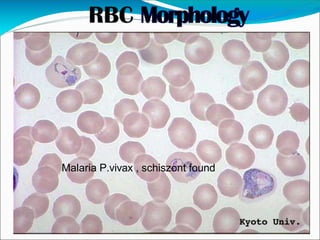 Malaria P.vivax , schiszont found
 