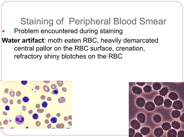Blood_Smear_Prep__eaf7622f.pptx | Blood Disorders | Diseases and Conditions