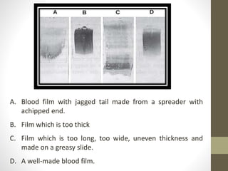 A. Blood film with jagged tail made from a spreader with
achipped end.
B. Film which is too thick
C. Film which is too long, too wide, uneven thickness and
made on a greasy slide.
D. A well-made blood film.
 