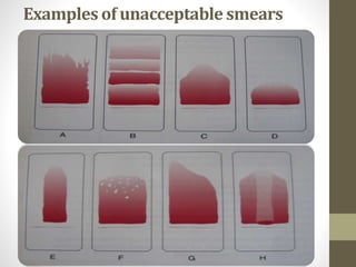 Examples of unacceptable smears
 