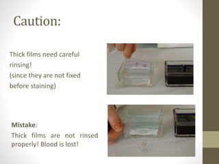 Caution:
Thick films need careful
rinsing!
(since they are not fixed
before staining)
Mistake:
Thick films are not rinsed
properly! Blood is lost!
 