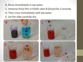 B. Rinse immediately in tap water
C. Immerse thick film in Field’s stain B (Eosin) for 3 seconds
D. Then rinse immediately with tap water
E. Let the slide carefully dry
 