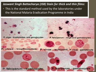 Jaswant Singh Battacharya (JSB) Stain for thick and thin films:
• This is the standard method used by the laboratories under
the National Malaria Eradication Programme in India
 