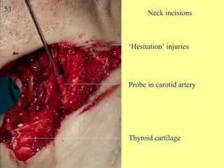 Neck incisions  Thyroid cartilage Probe in carotid artery ‘ Hesitation’ injuries 53 