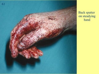 Back spatter  on steadying hand 61 