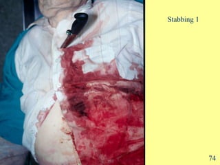 Stabbing 1 74 