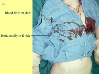 Blood flow on shirt Horizontally to R side 76 