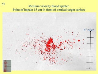 Medium velocity blood spatter. Point of impact 15 cm in front of vertical target surface 6” ruler 55 
